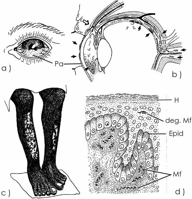 Effects of Onchocerciasis