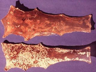 Onchocera armillata in the aortic wall of cattle (A. Renz)